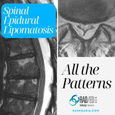 spinal epidural lipomatosis lumbar