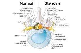 lumbar stenosis causes symptoms and