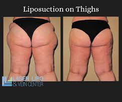anterior thigh liposuction
