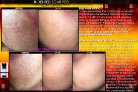 indented acne scar removal l en