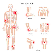 how do you treat bursitis in the knee