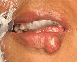 case of an uncommon lower lip swelling