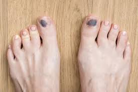 black toenails from running