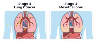 There is another, more formal system to describe the stage of lung cancer, but sclc is almost always staged as limited or extensive stage as described above. Pleural Mesothelioma Vs Lung Cancer Diagnosis Treatment