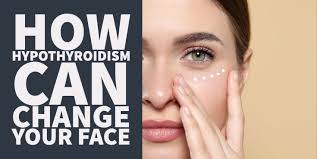 8 ways hypothyroidism can change your face
