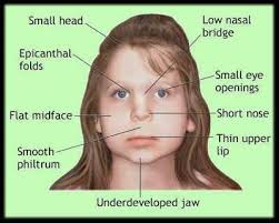 Flat nasal bridge and epicanthal folds : Foetal Alcohol Syndrome Hurt
