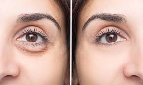 remove dark circles naturally with home
