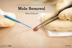 mole removal what to know by dr