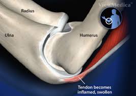 triceps tendonitis treatment