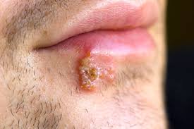 cold sores pics types causes