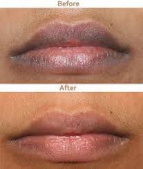 dark lips treatment at best in