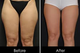 what to do about inner thigh sagging