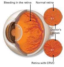 retinal vein occlusion macula retina