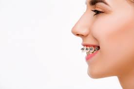 what is overjet teeth brite orthodontics