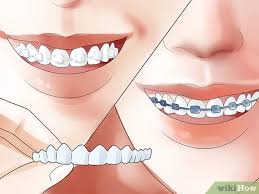 Add something to the front of the tooth to make the front of the tooth aligned and give the illusion of straight teeth. 4 Ways To Make Your Teeth Straight Wikihow