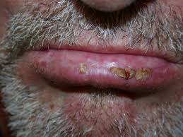 actinic cheilitis pictures lip