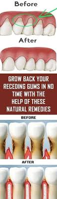 grow back your receding gums with