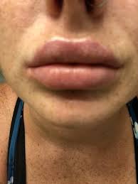 after juvederm xc injection photos