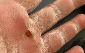 how to deal with calluses from lifting