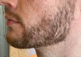 I do not rub in the solution to my scalp after i'm done dabbing it. What Happened When I Came Off Minoxidil After 2 Years For My Beard