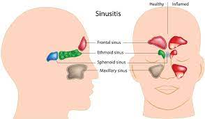 acute and chronic sinusitis and allergies