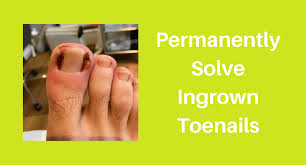 the rise of ingrown toenails