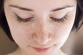 for freckles treatment