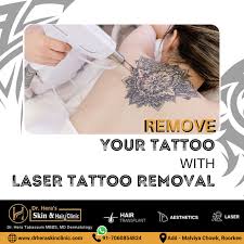 in roorkee laser tattoo removal services