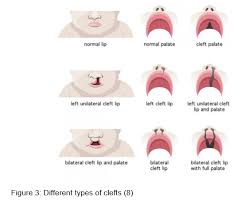 cleft lip and palate in neonates