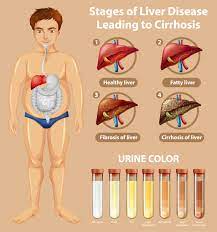 Cirrhosis is the twelfth leading cause of death by disease, killing about 26,000 people each year. Stages Of Liver Disease Educational Diagram Download Free Vectors Clipart Graphics Vector Art