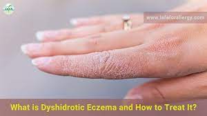 what is dyshidrotic eczema and how to