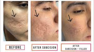 subcision filler for acne scars you