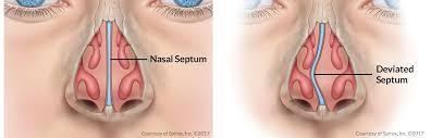 The septum is the dividing wall between the left and right nasal passages. Deviated Septum Surgery Troy Nose Breathing Relief Bloomfield