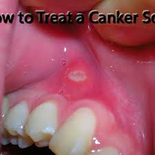 how to treat mouth sores hubpages