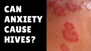 In many ways, anxiety may be considered it's not clear why anxiety and stress seem to contribute to each other, but there are several proposed. Can Anxiety Cause Hives Relieve Symptoms Fast Using Oatmeal Youtube