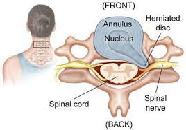 herniated disc in the neck and