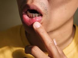 mouth sores pictures causes types
