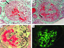 Diffuse Extracapillary Proliferation In