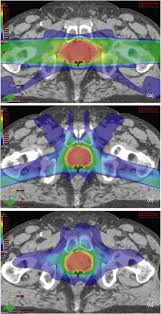 conformal radiotherapy an overview
