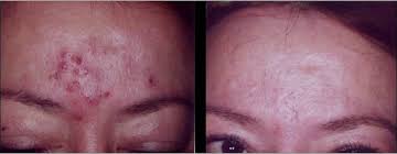 see which laser or light treatment is