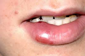 swollen lip stock image m330 1396