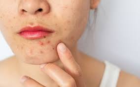 hyperpigmentation around mouth causes