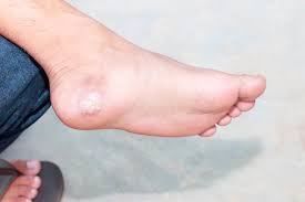 plantar warts in kids what you need to