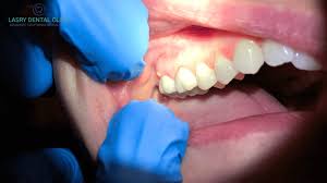 abscessed tooth cause treatment and