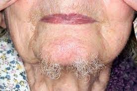 hair growth on the chin of a woman