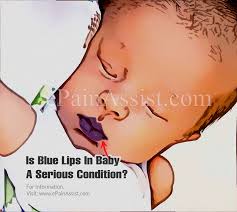 is blue lips in baby a serious condition