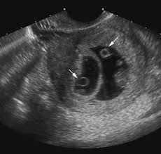 But there are actually some potential risks when it comes to ultrasounds. Ultrasound Evaluation Of Multiple Pregnancies Radiology Key