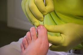 ingrown toenail specialist in quincy ma