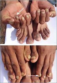isolated hereditary nail disorders
