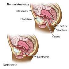 rectocele what you need to know